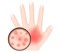 ayurvedic treatment for dermatitis