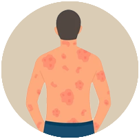 eczema treatment with ayurveda