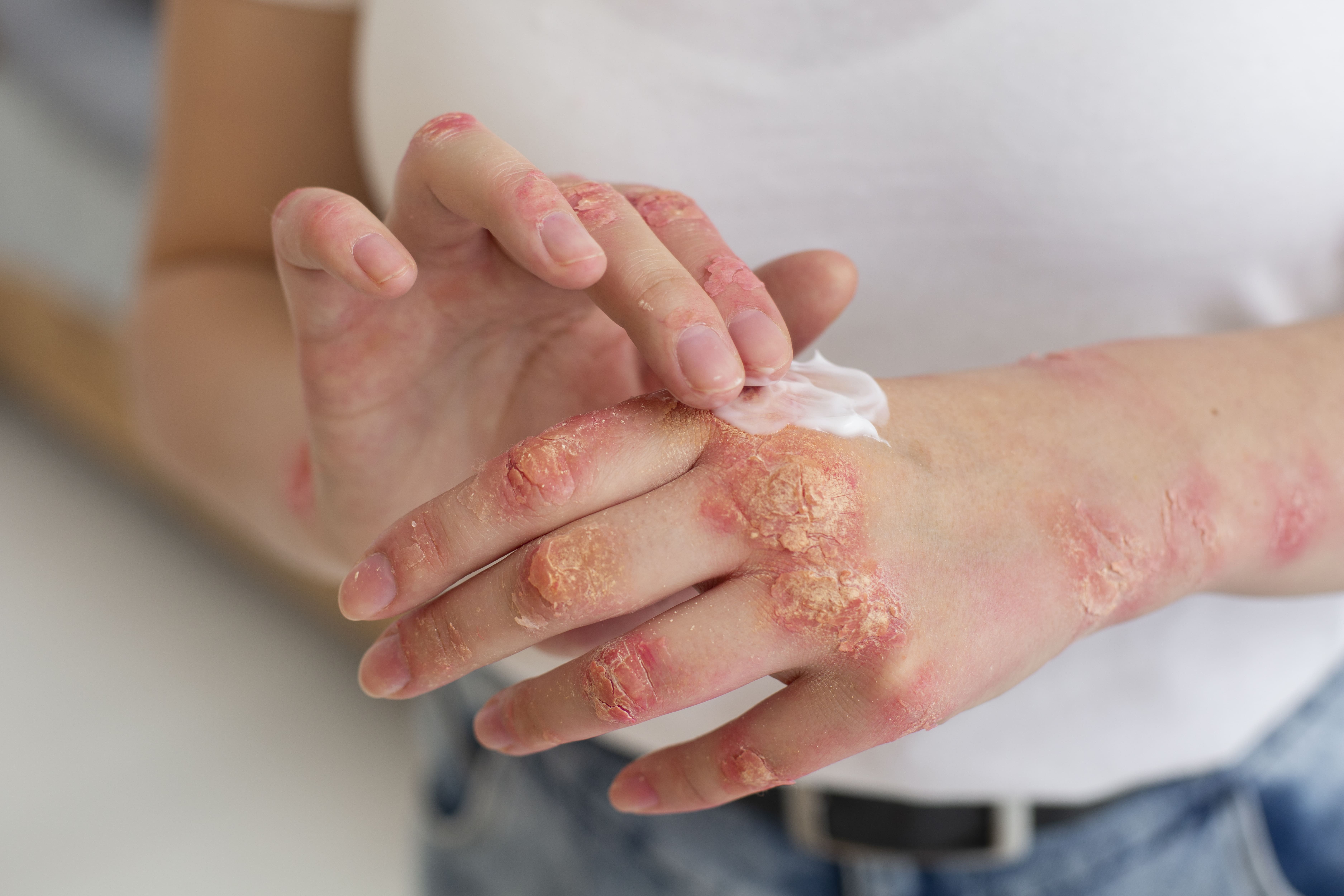 psoriasis treatment in ayurvedic